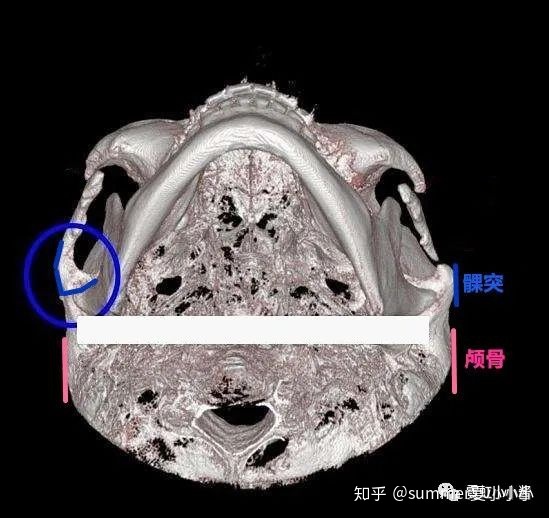 而且容易出现上窄下宽的梨形脸型,正脸最宽处仍然是髁突处.    ▽