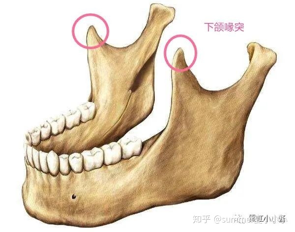 下颌髁突宽的人,做了颧骨截骨,即使内推程度很大,也无法突破髁突的